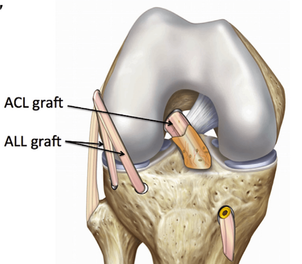Schéma de reconstruction du LCA par greffe tendineuse