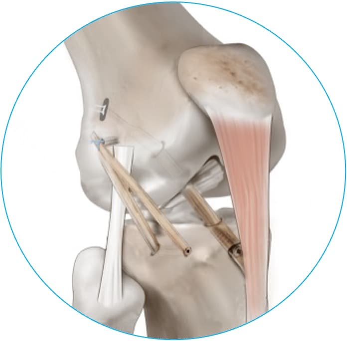 Schéma de ligamentoplastie LCA — vue 3