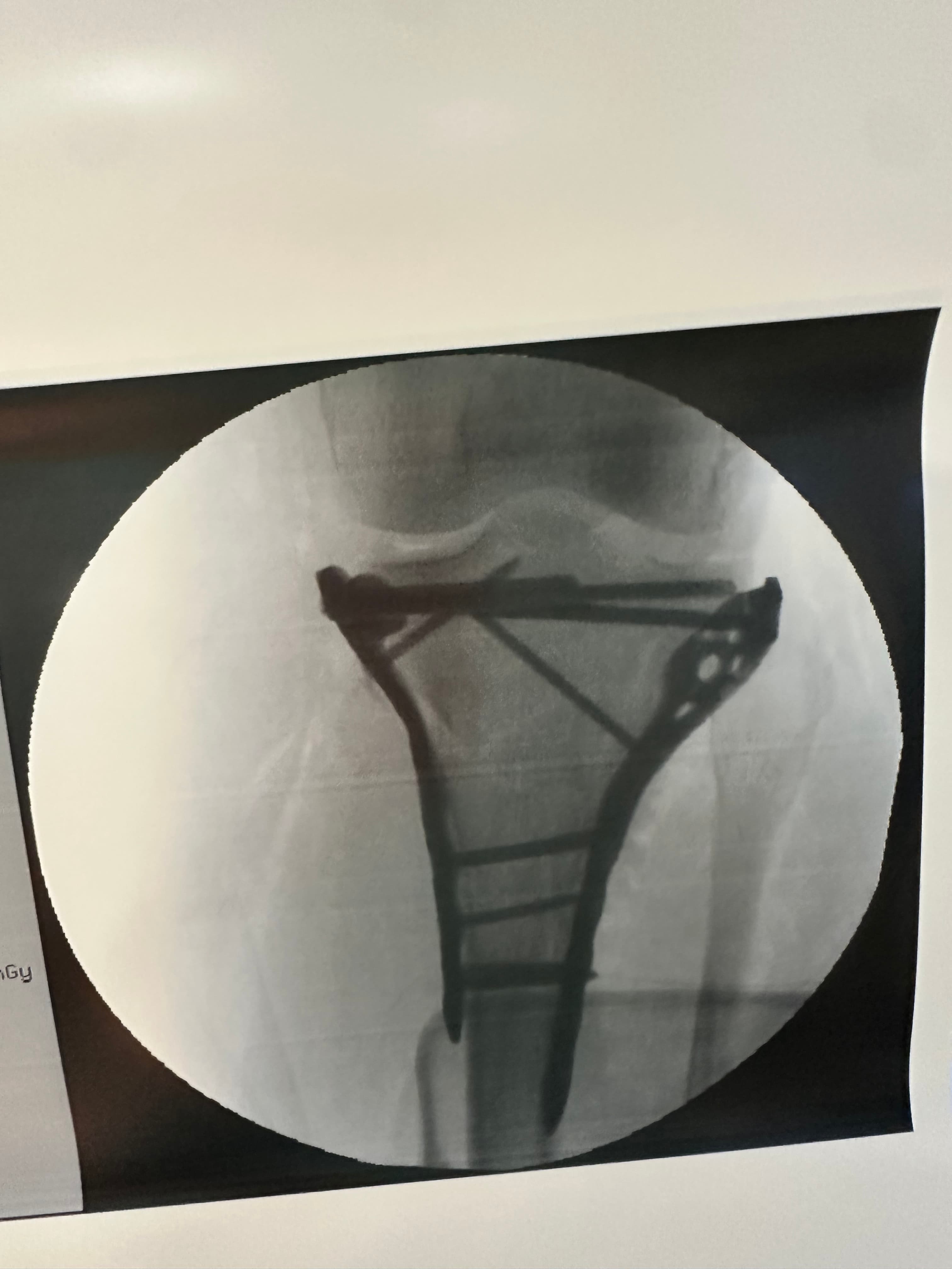 Radiographie du plateau tibial — vue 2
