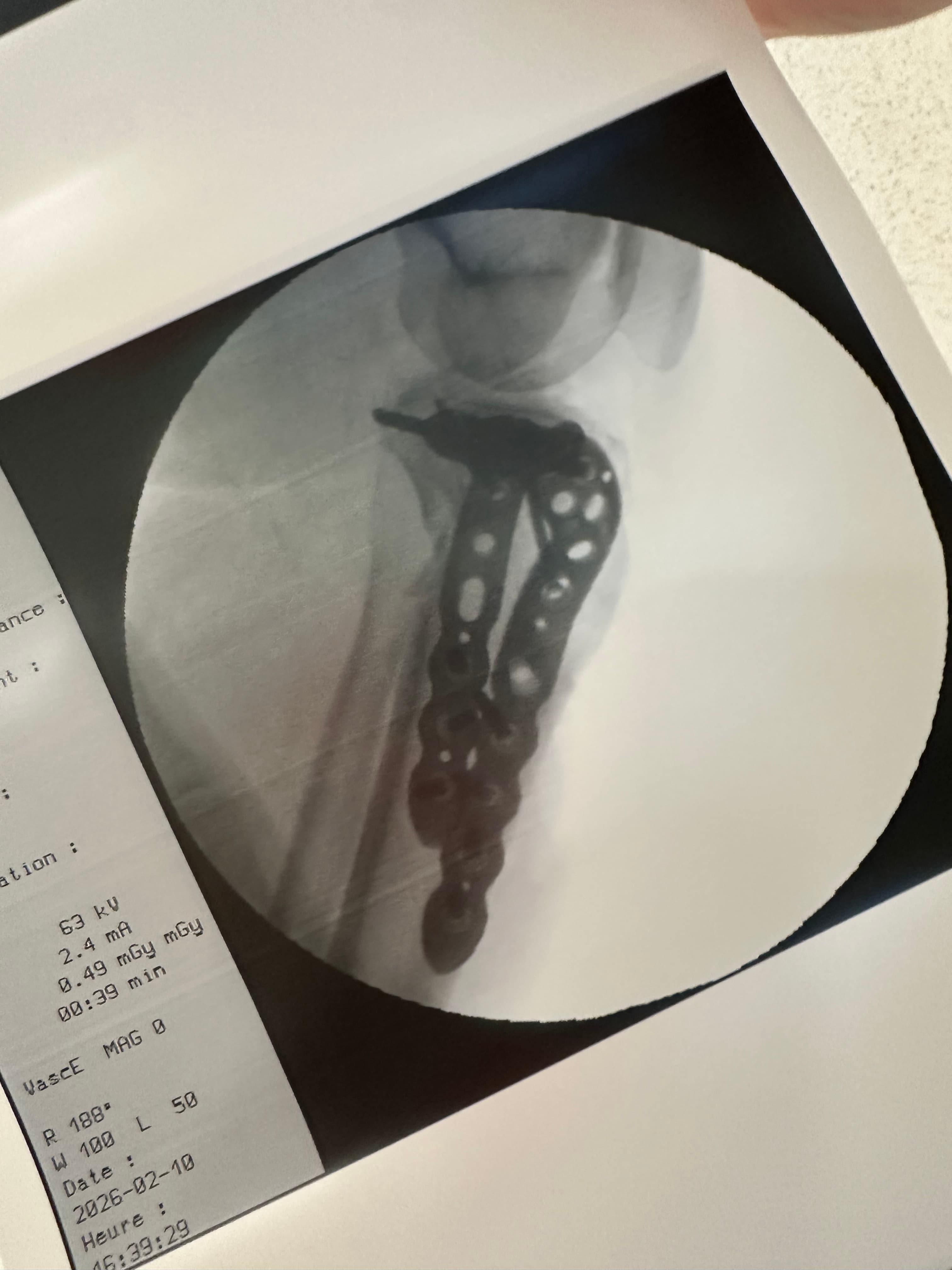 Radiographie de profil du plateau tibial