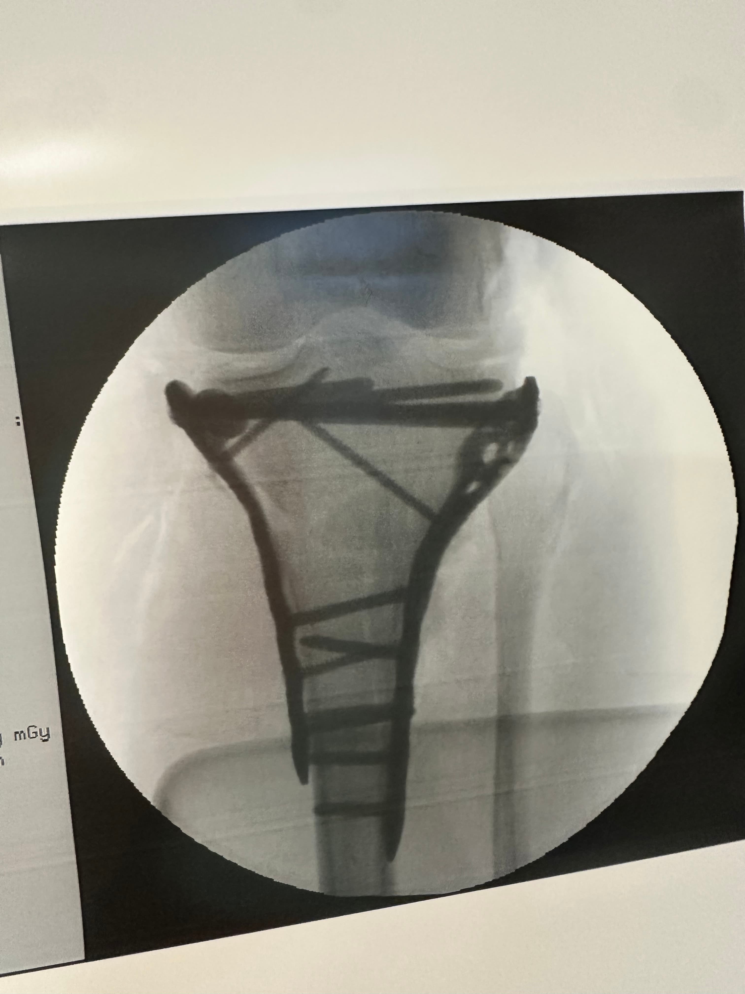 Radiographie du plateau tibial