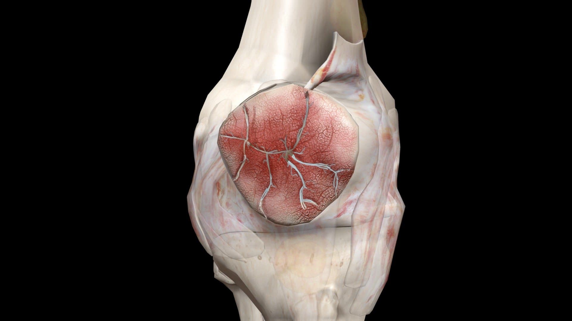 Reconstruction 3D d'une fracture de rotule