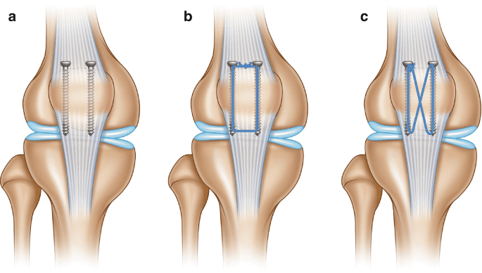Ostéosynthèse de fracture de rotule — vue 2