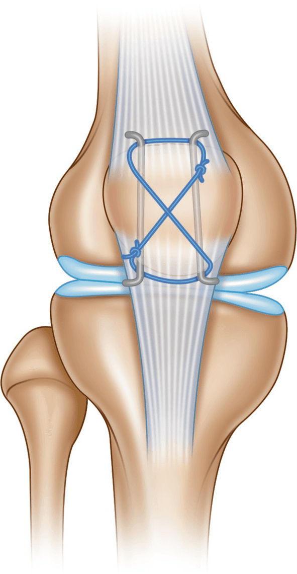 Ostéosynthèse de fracture de rotule — résultat radiologique