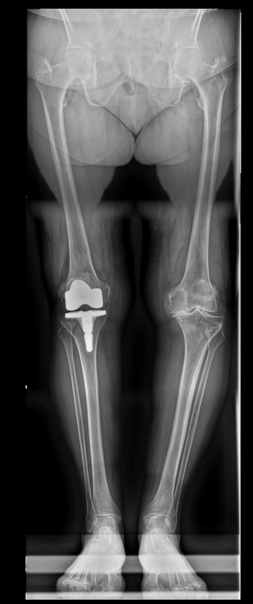 Goniométrie axe fémoro-tibial — planification préopératoire PTG