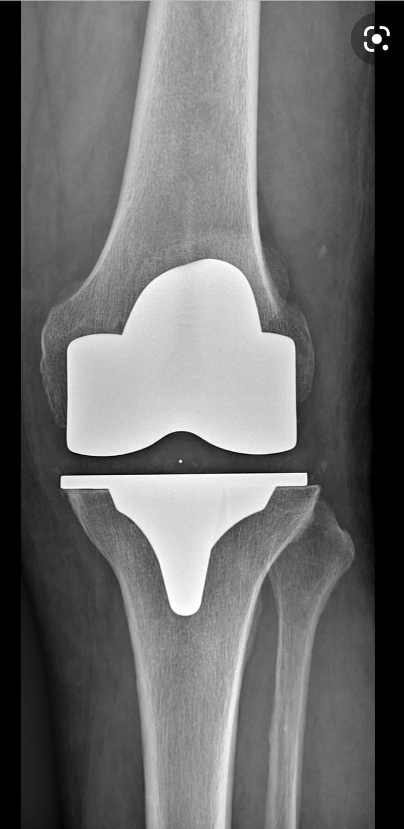 Radiographie post-opératoire après prothèse totale de genou