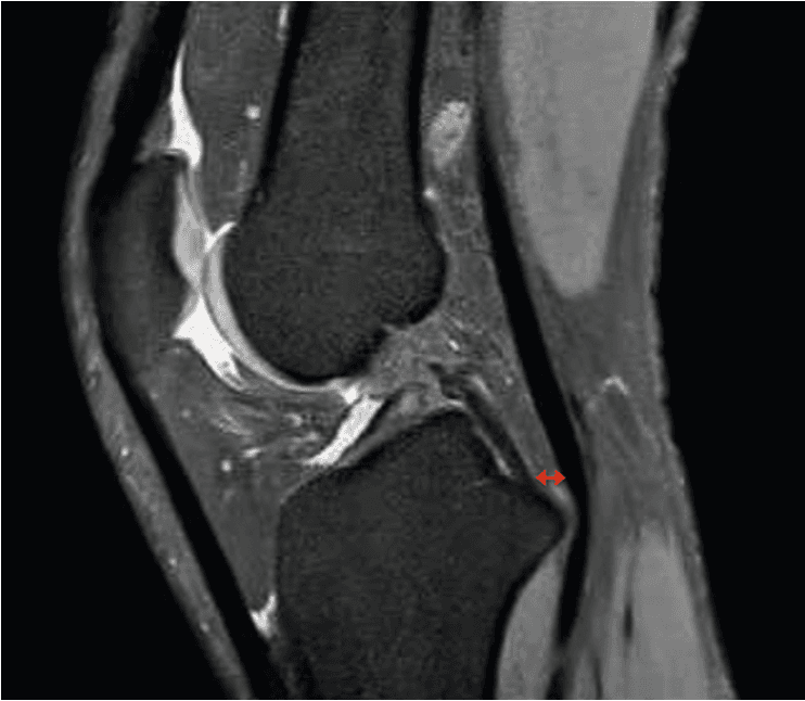 IRM d'une rupture du ligament croisé postérieur