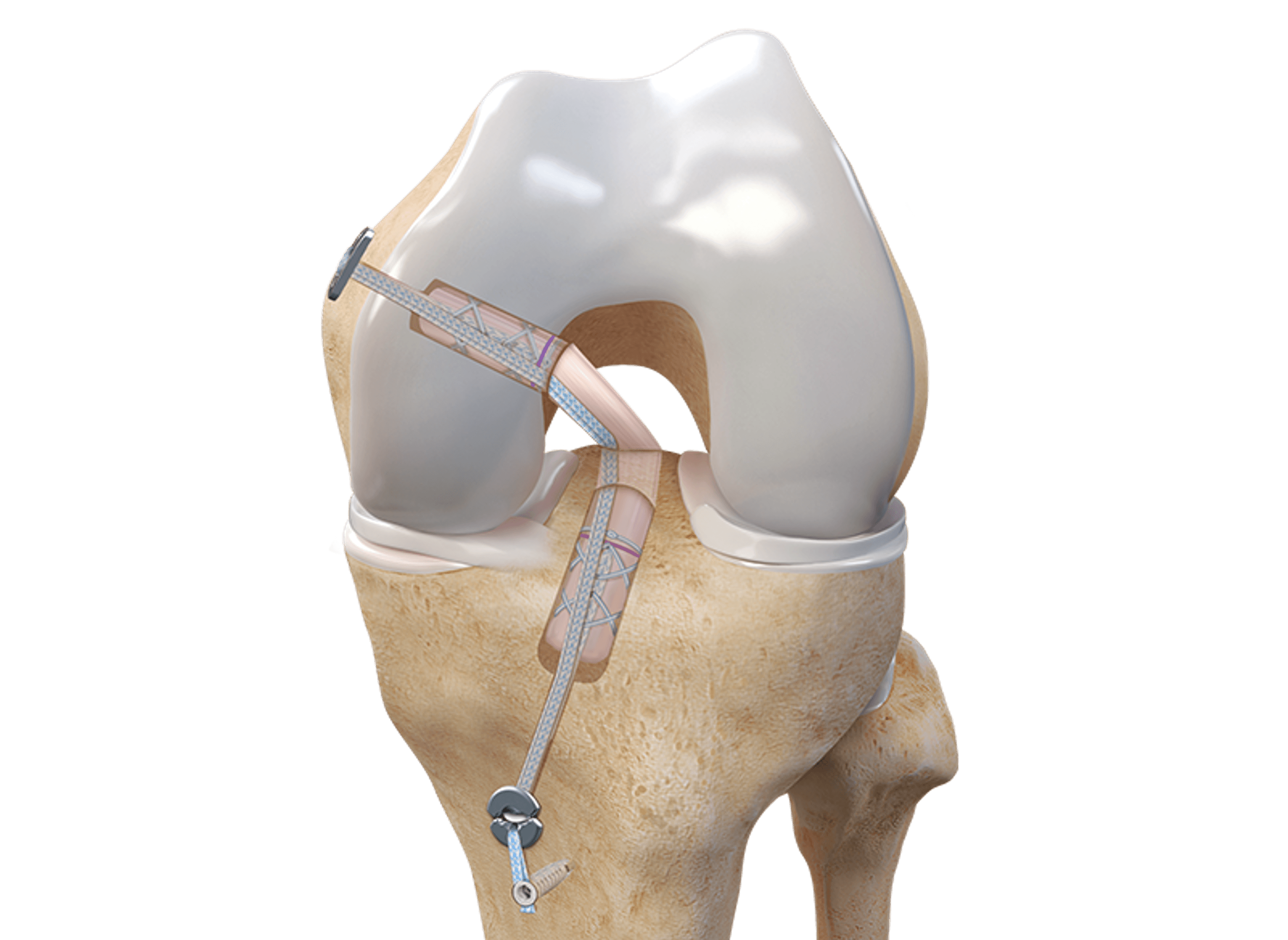 Schéma de reconstruction du ligament croisé postérieur
