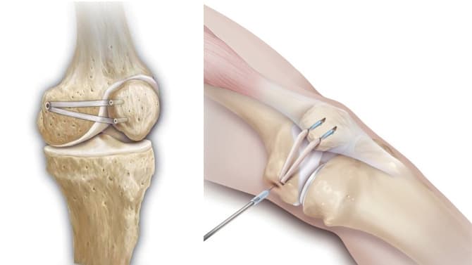 Ligament fémoro-patellaire médial (MPFL) — anatomie et reconstruction