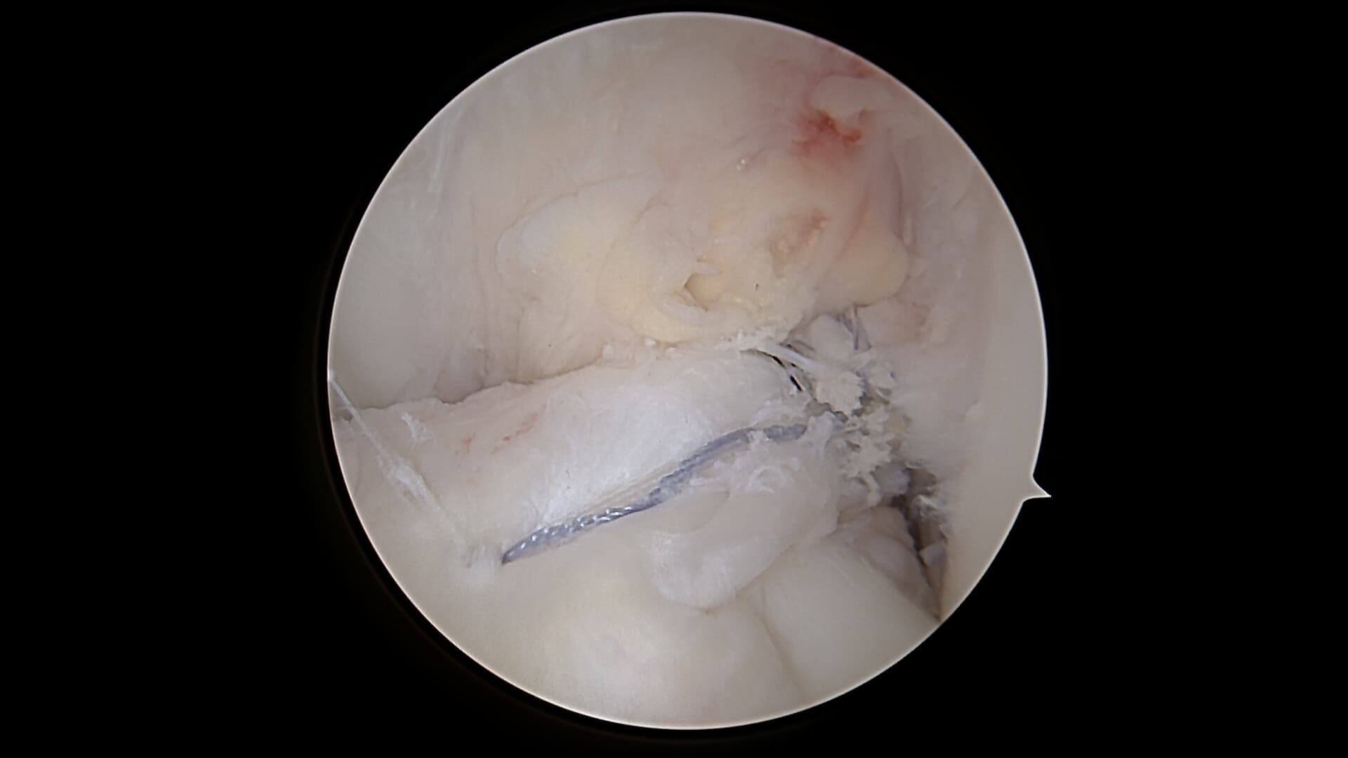 Réparation du ligament croisé antérieur (LCA)