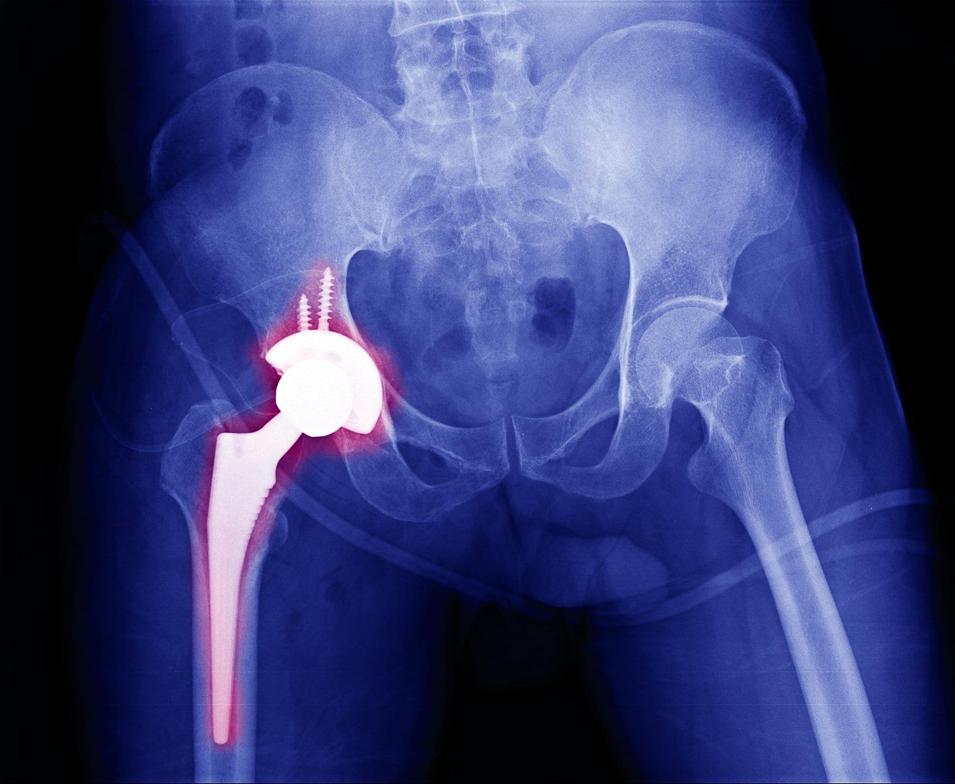 Radiographie d'une prothèse de hanche descellée, indication de révision