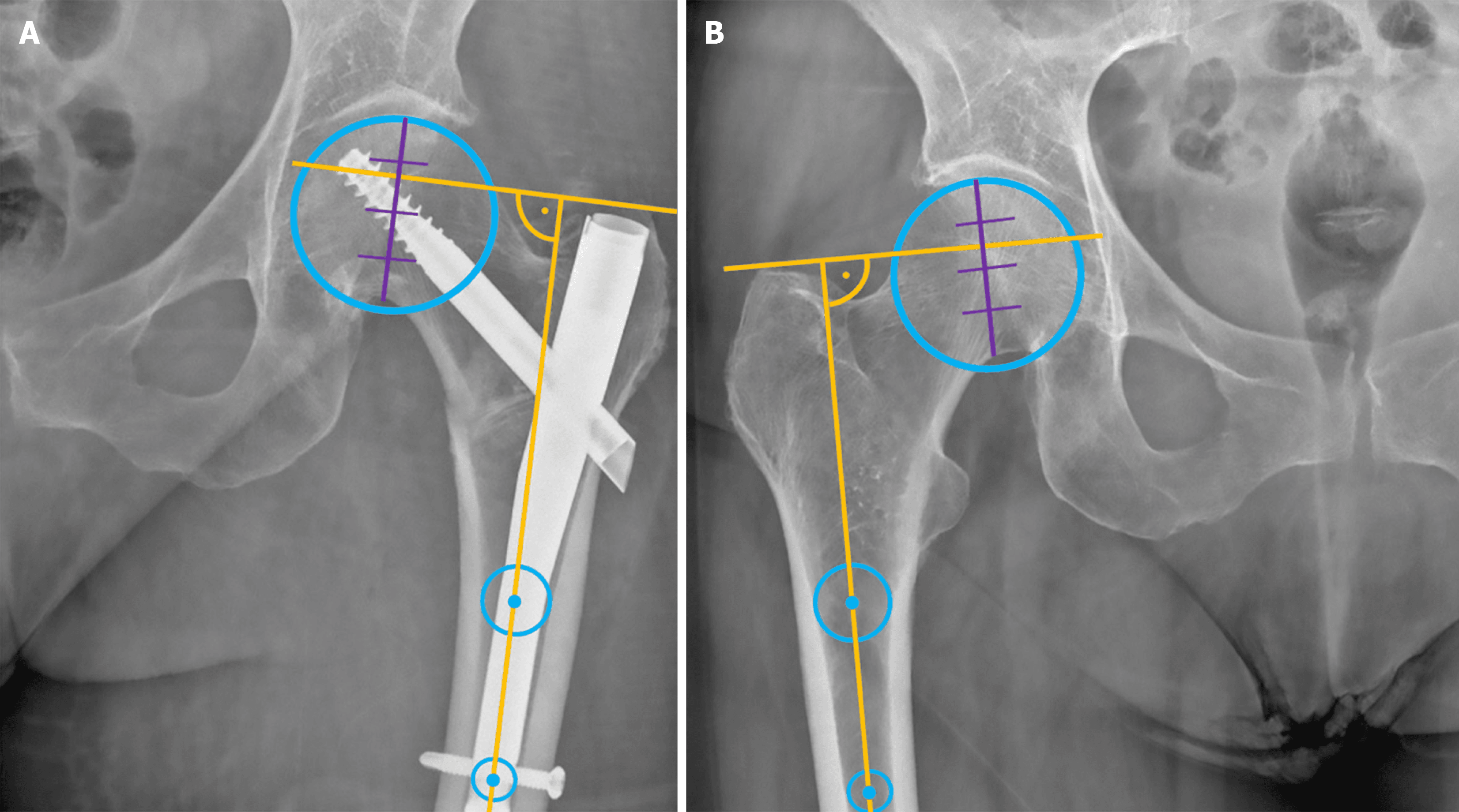 Clou gamma — vue schématique en coupe frontale du fémur proximal
