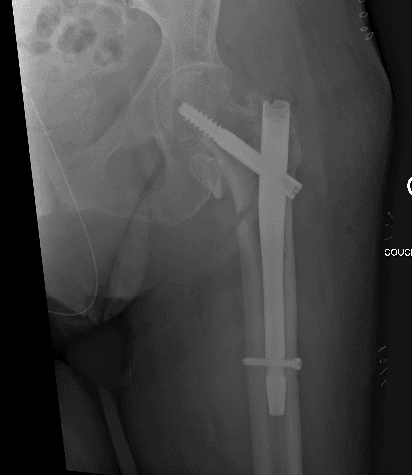 Schéma d'un enclouage centromédullaire avec clou gamma — fixation trochantérienne