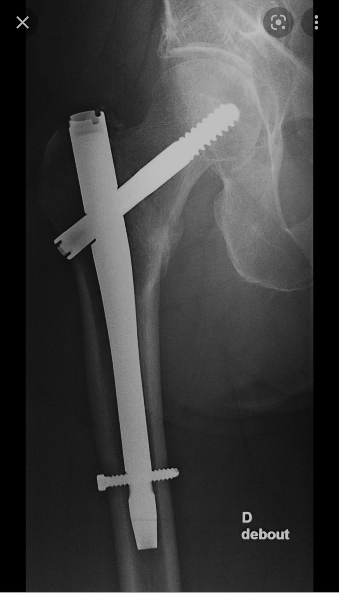 Clou gamma intramédullaire pour fracture pertrochantérienne fémorale