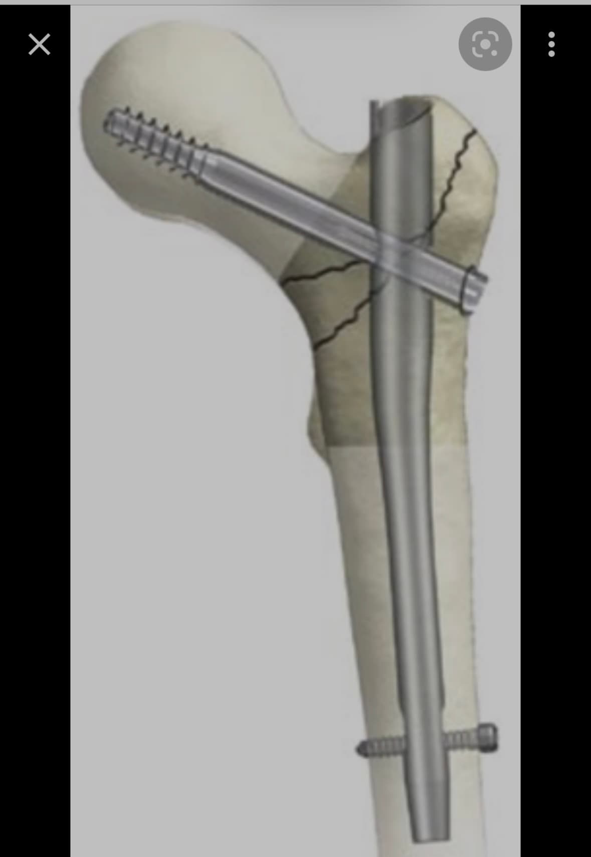 Schéma comparatif : vis-plaque et clou gamma pour fracture pertrochantérienne