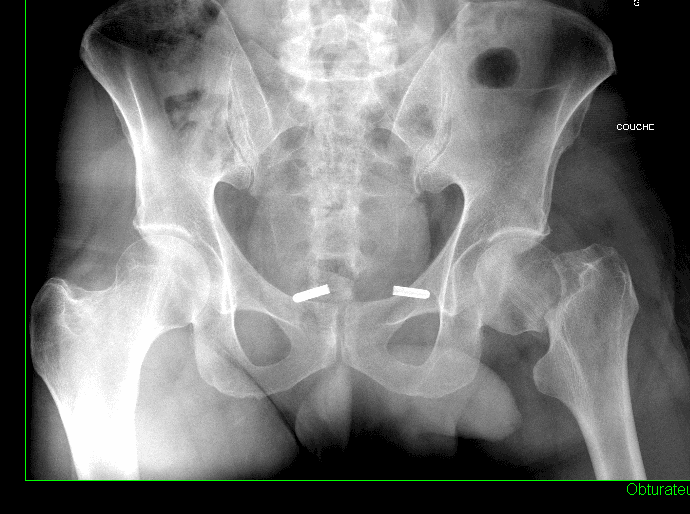 Radiographie de face d'une fracture du col fémoral déplacée