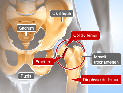 Schéma anatomique d'une fracture du col fémoral