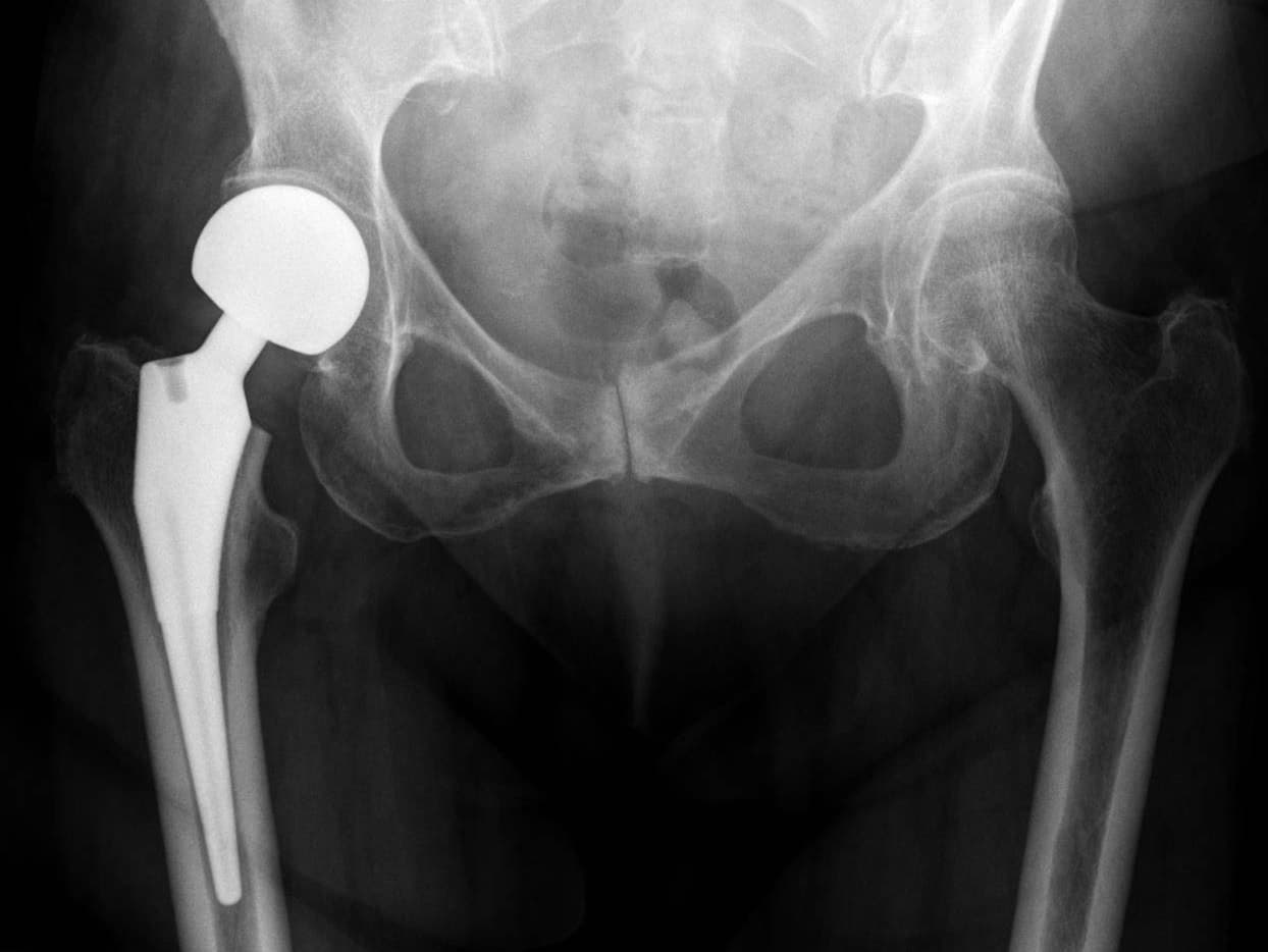 Radiographie post-opératoire d'une prothèse intermédiaire de hanche