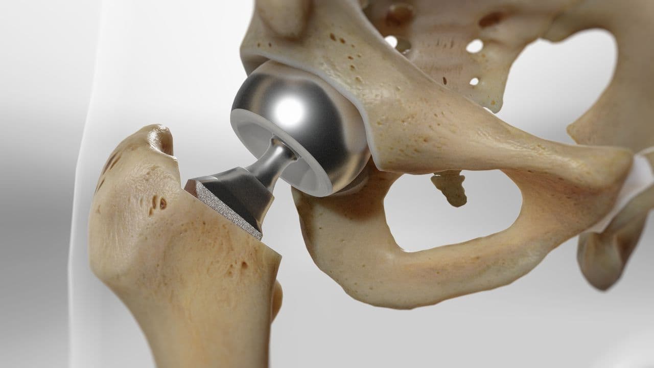 Schéma d'une prothèse intermédiaire de hanche (hémiarthroplastie)