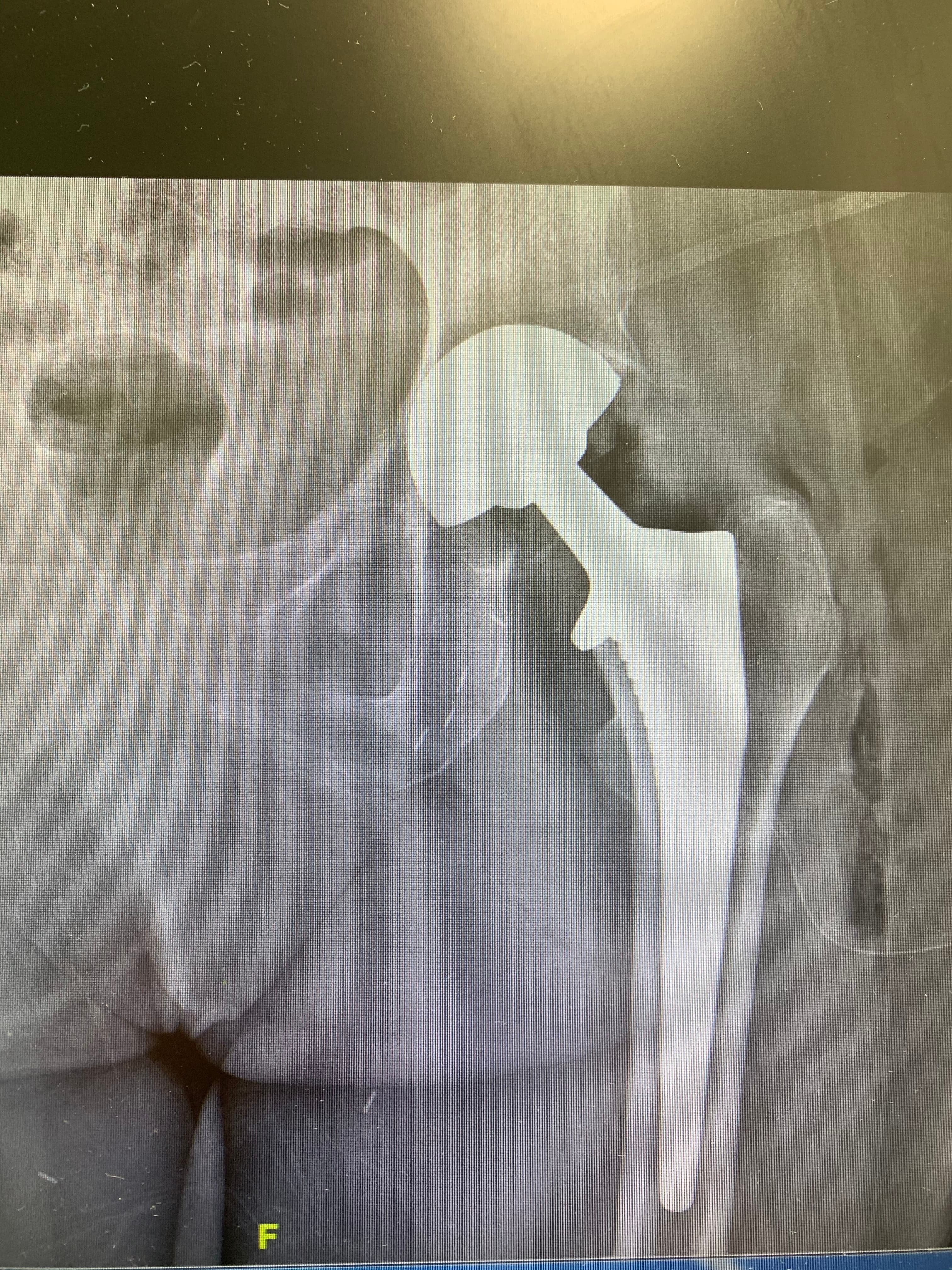 Radiographie de face d'une prothèse totale de hanche en place