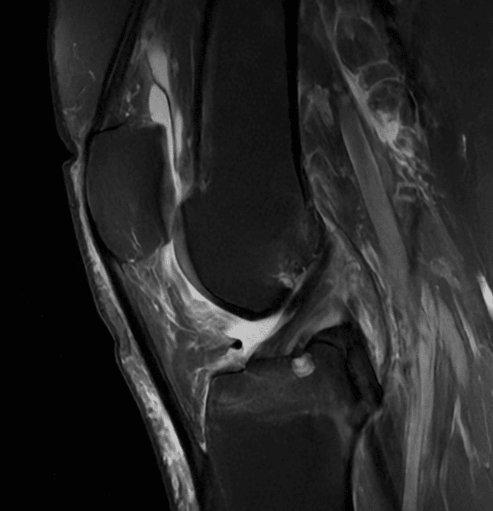 IRM d'un ligament croisé antérieur intact pour comparaison