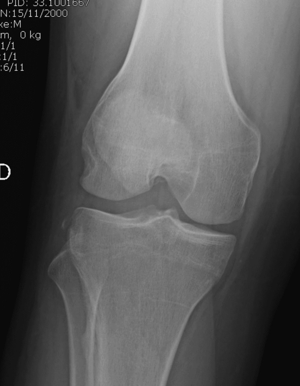 Radiographie du genou après entorse grave