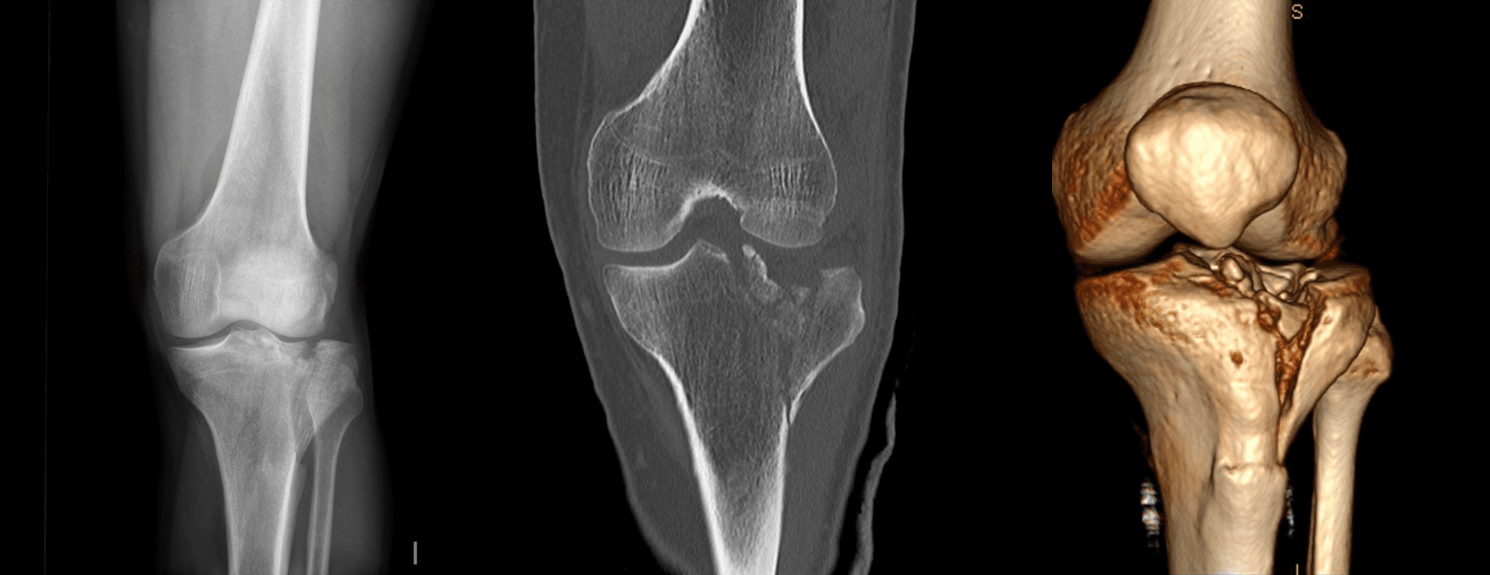 Reconstruction 3D d'une fracture du plateau tibial