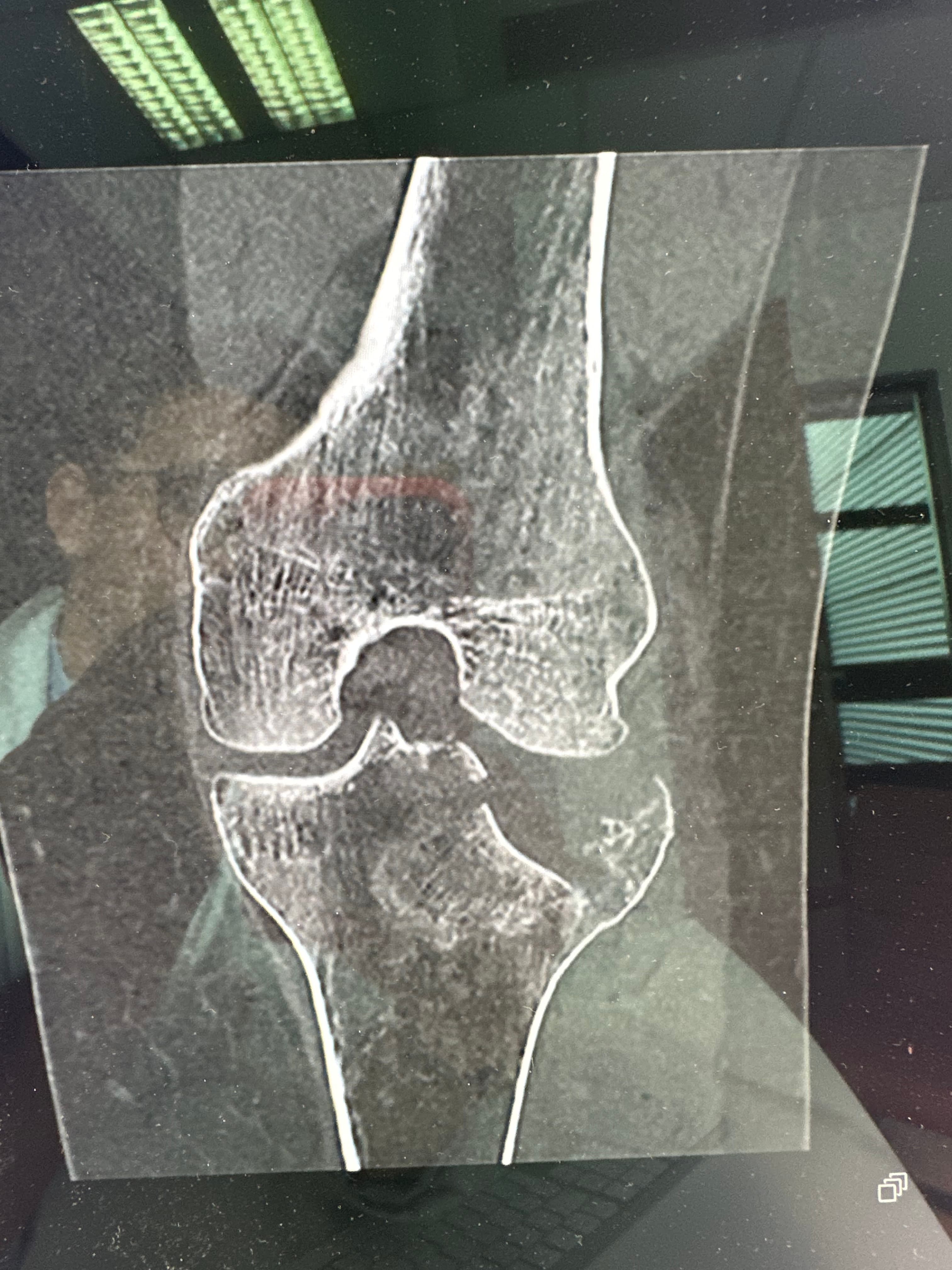 Scanner préopératoire d'une fracture du plateau tibial