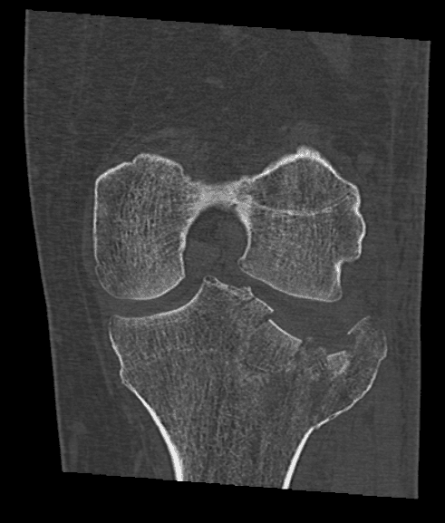 Scanner du plateau tibial fracturé
