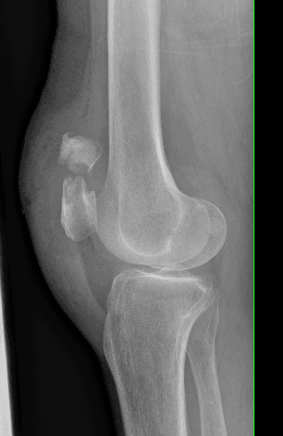 Radiographie d'une fracture de rotule