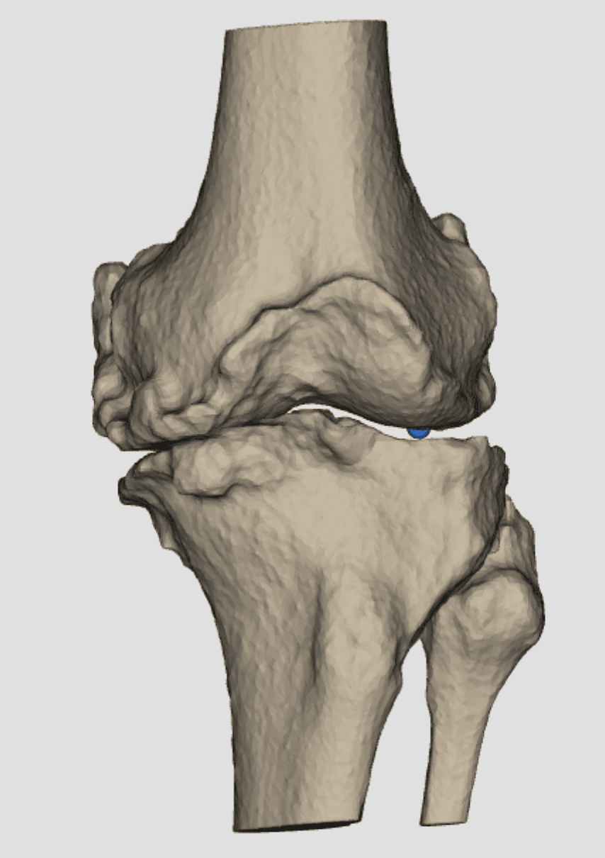 Reconstruction 3D d'un genou gonarthrosique