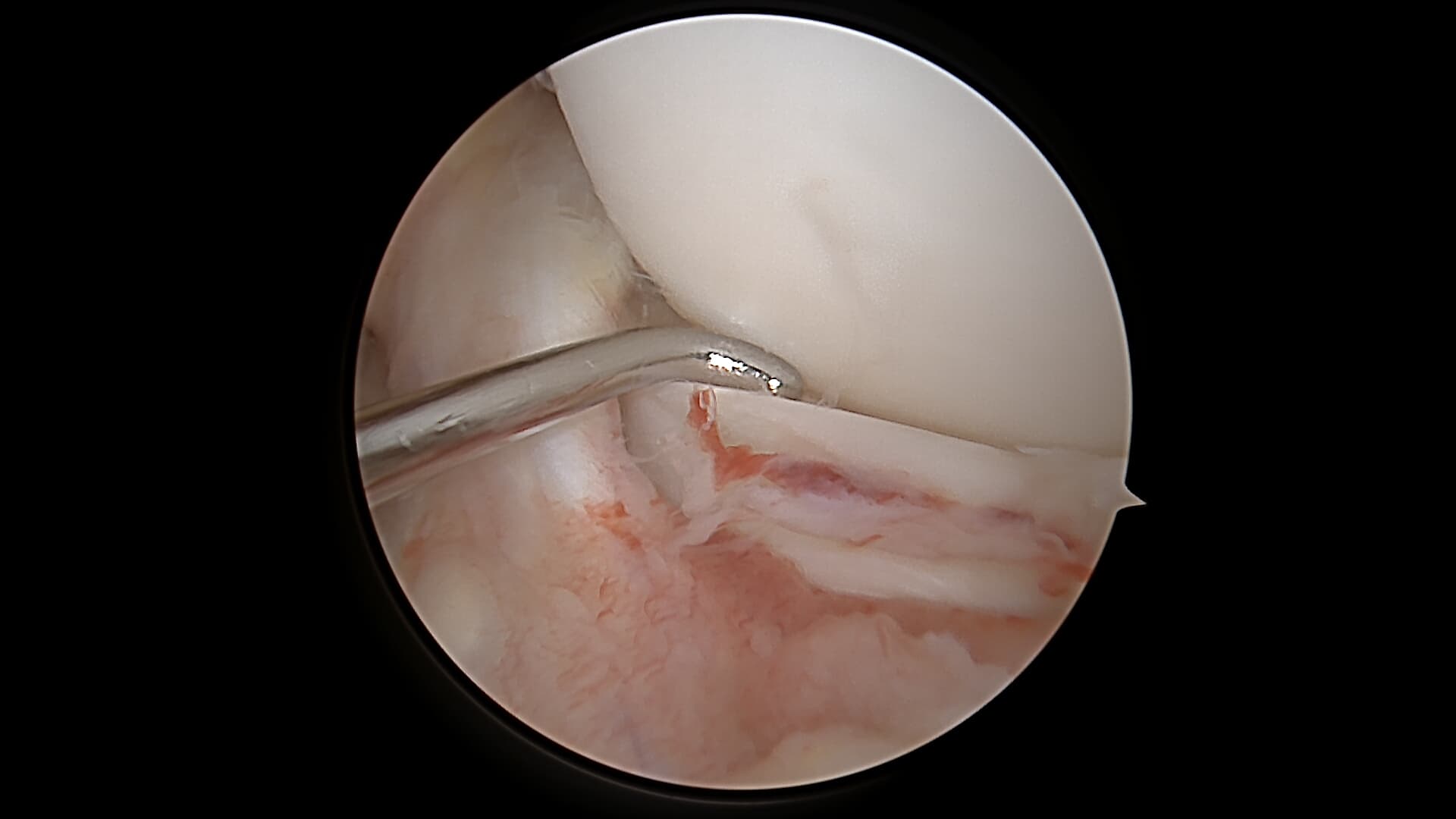 Vue arthroscopique d'une lésion méniscale en anse de seau