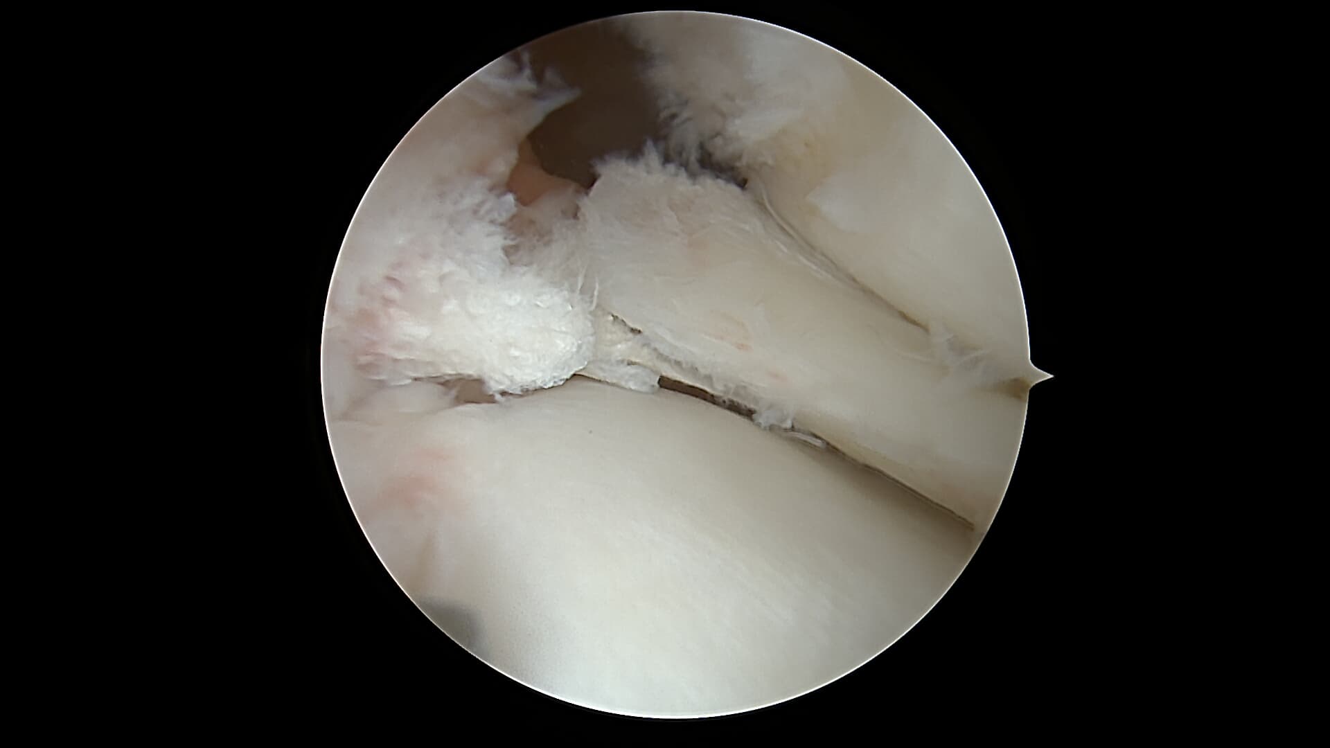 Vue arthroscopique d'une lésion de racine méniscale
