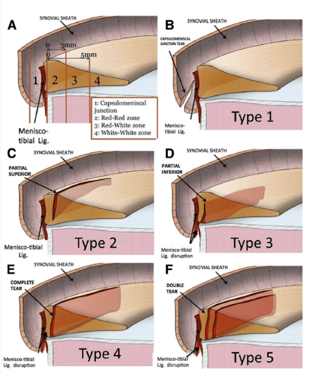 Classification de Thaunat des Ramp Lésions