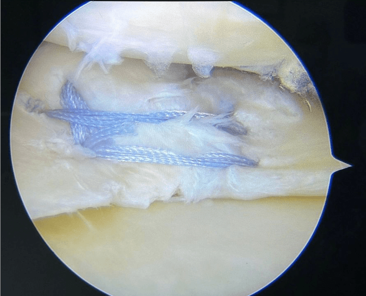 Réparation d'une lésion horizontale du ménisque par 3 points de sutures
