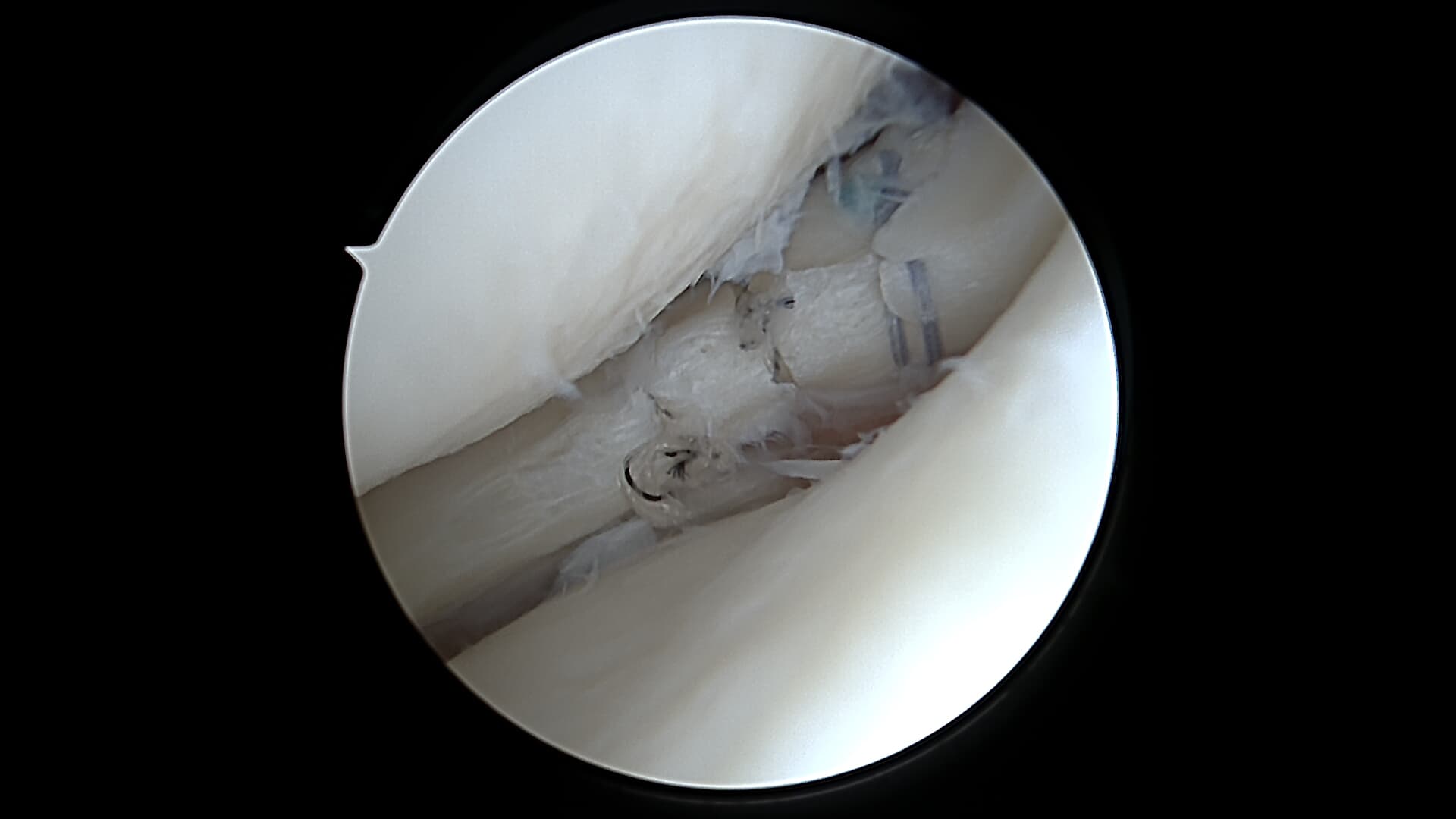 Réparation d'une lésion horizontale du ménisque par 3 points de sutures