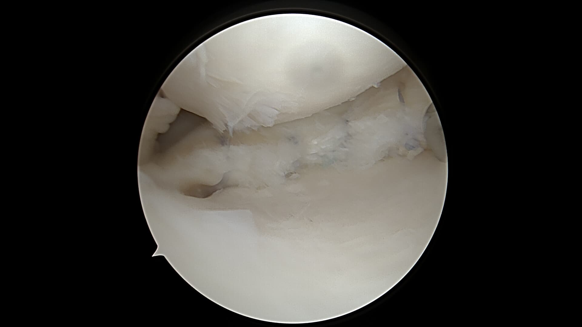 Vue arthroscopique d'une lésion de racine méniscale