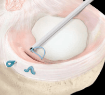 Dispositif de suture méniscale All-inside avec ancres filaires