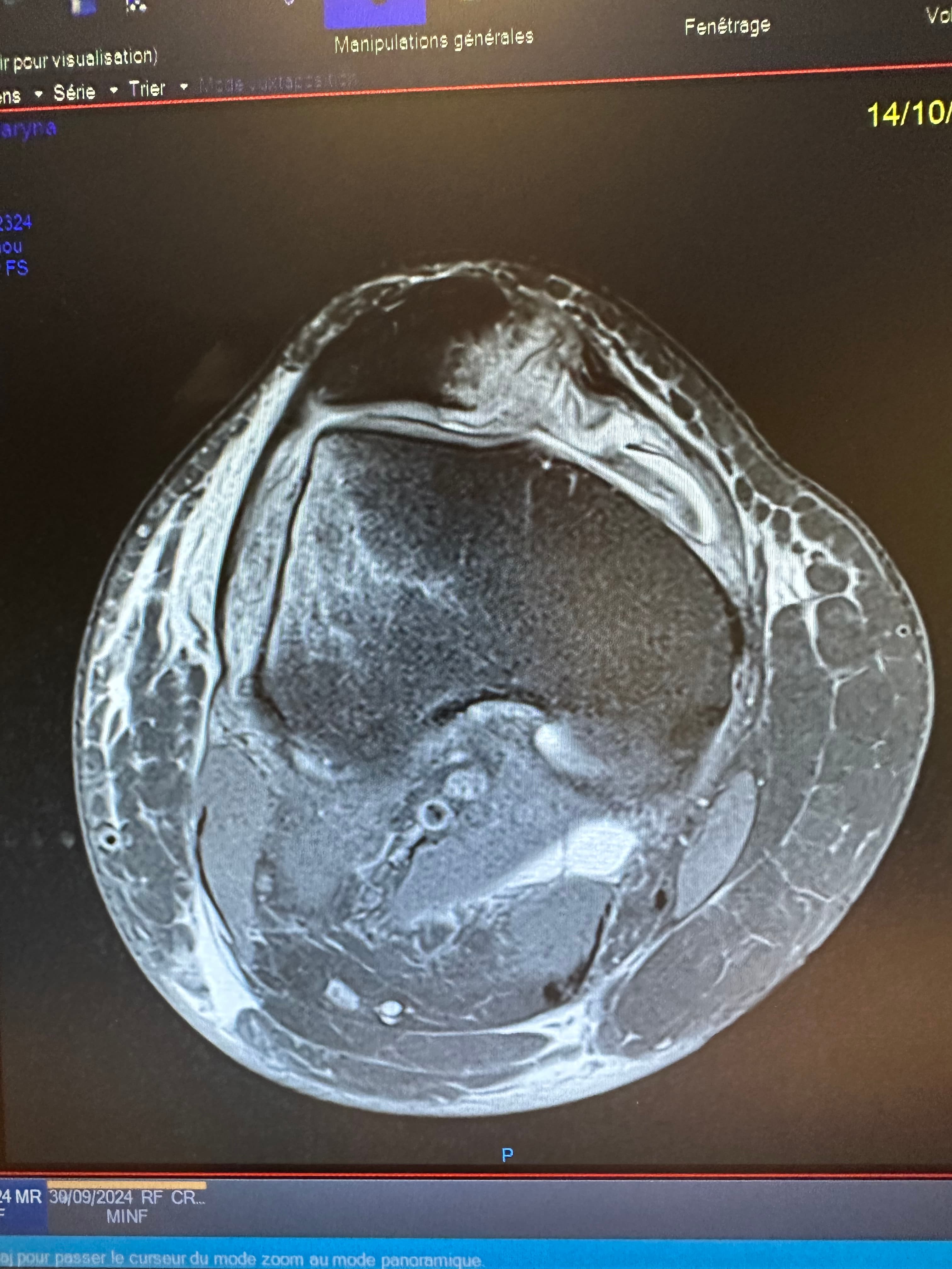 IRM montrant un bone bruise après luxation de rotule