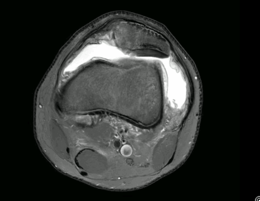 IRM montrant une rupture du ligament fémoro-patellaire médial