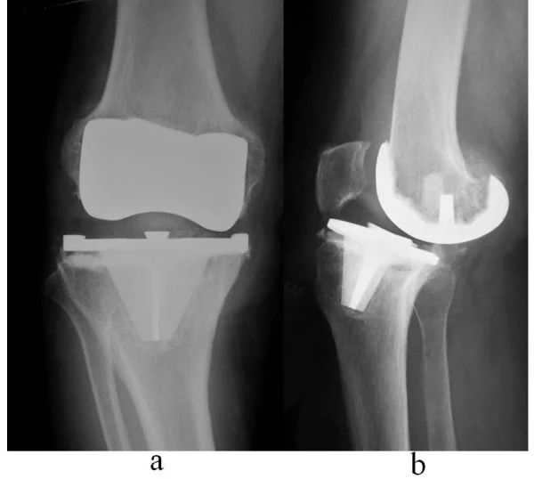 Radiographie d'une luxation de prothèse totale de genou