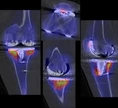 SPECT-CT d'une prothèse de genou douloureuse