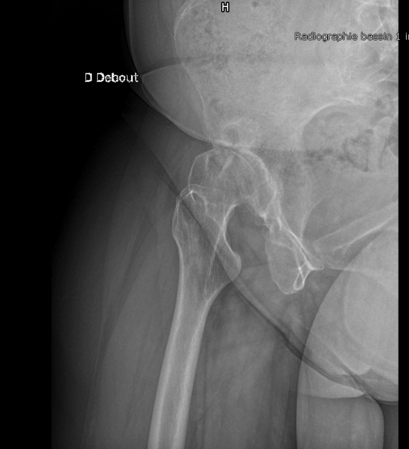 Radiographie de profil d'une hanche arthrosique dysplasique