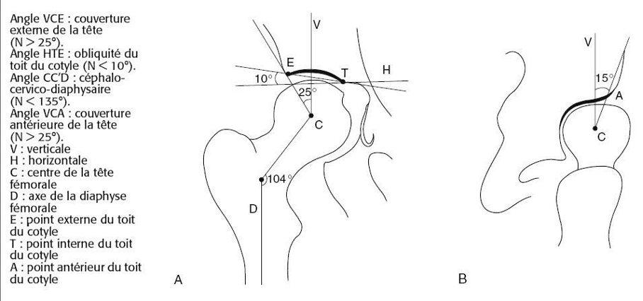 Schéma anatomique de l'arthrose de la hanche