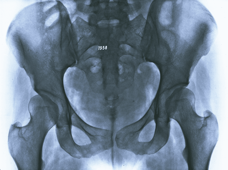 Radiographie d'arthrose secondaire à une dysplasie de hanche