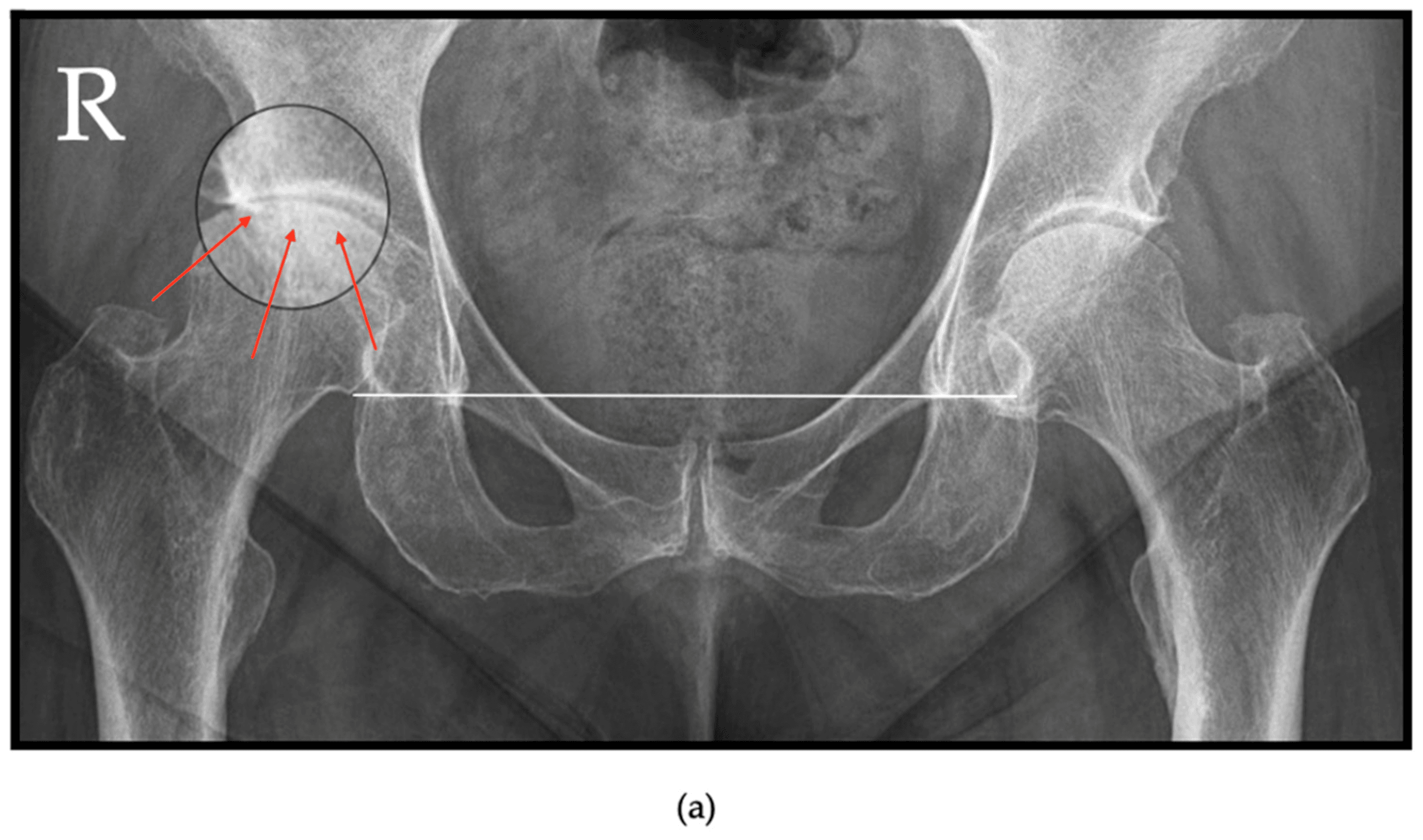 Radiographie de coxarthrose de face