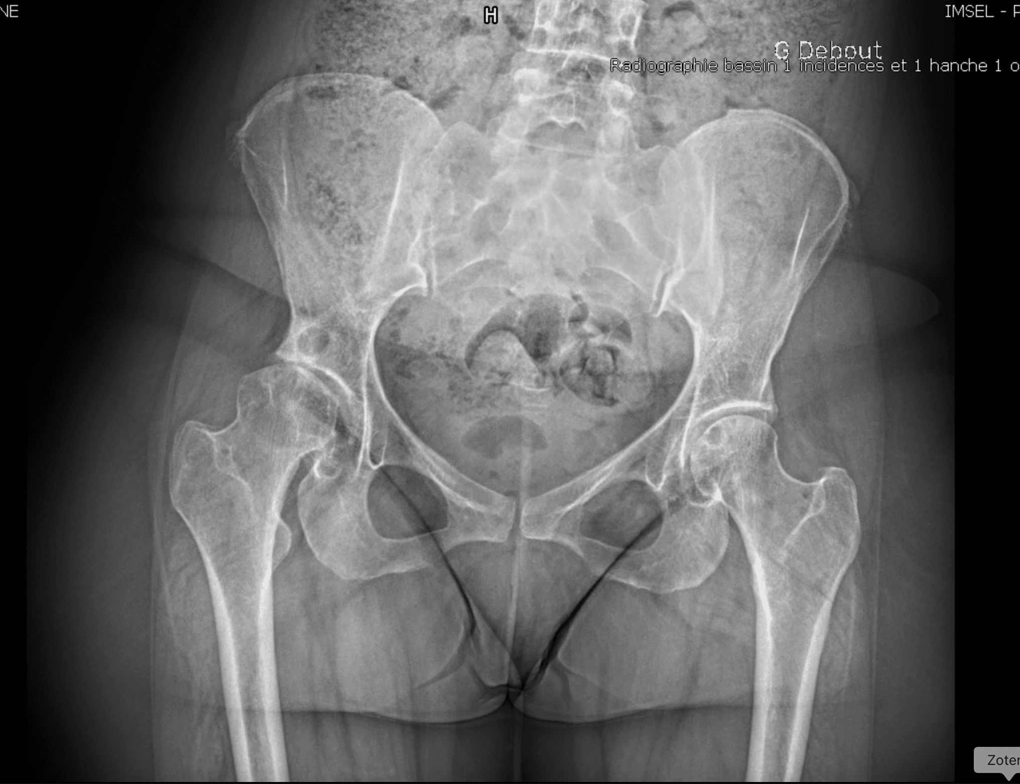 Radiographie d'arthrose secondaire à une dysplasie de hanche