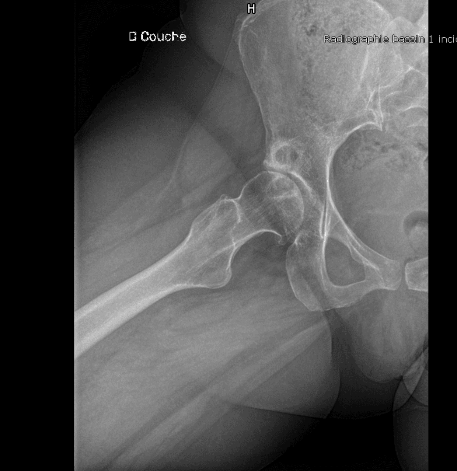 Radiographie de dysplasie de hanche en incidence de Dunn