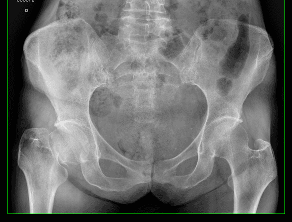 Radiographie de fracture du col fémoral, vue 2