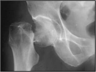 Radiographie de fracture du col fémoral de face
